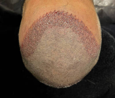ギャラリー｜Hair Transplant Prices in Riyadh